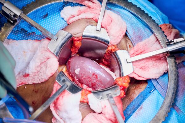 The gene-edited pig kidney moments after blood vessels are reattached and the organ is reperfused with Towana Looney’s blood at NYU Langone Health in New York City on Nov. 25, 2024. (Joe Carrotta/NYU Langone Health via AP)